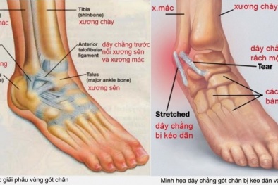 Ghép gân phức tạp như thế nào?