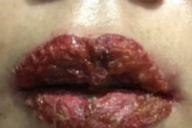 Môi chảy mủ vì ‘nhắm mắt’ nghe dụ dỗ đi phun xăm