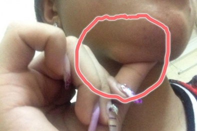 'Cằm méo, mắt trợn' do tiêm chất làm đầy dởm: Hậu quả còn mãi
