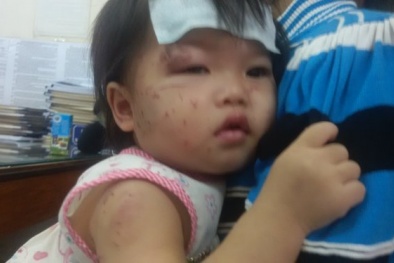 Bé 1 tuổi chi chít vết cào cấu khi đi nhà trẻ: Xác định được nguyên nhân nhập viện