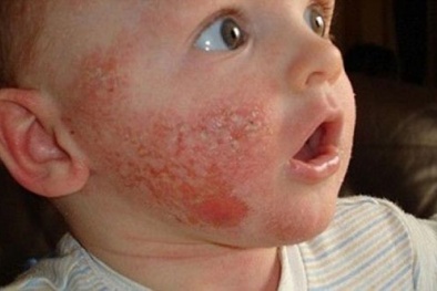 Rúng động vụ 7 trẻ mới tập đi bị tạt axit trong nhà hàng