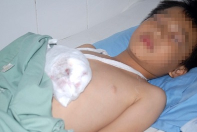 Sạc đèn pin phát nổ khi đang ngủ, bé trai dập nát bàn tay phải