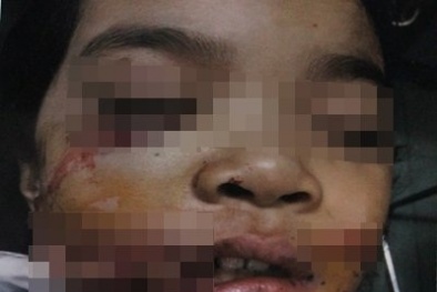Bình Phước: Bé gái phải khâu 7,5 mét chỉ vì bị chó cắn nát mặt