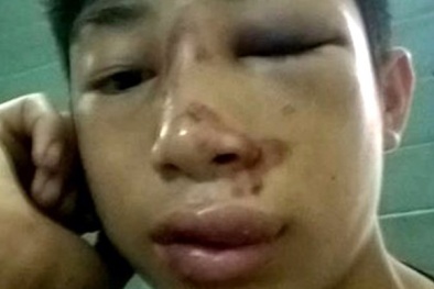 Trưởng công an xã bị tố đánh một học sinh nhập viện