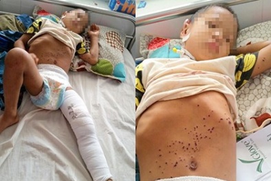 Nghịch kíp nổ vì tưởng là đồ chơi, bé 8 tuổi gãy xương lồi cầu