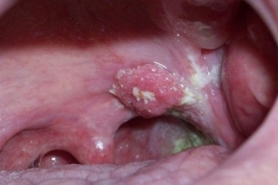 Ung thư vòm họng sống được bao lâu?