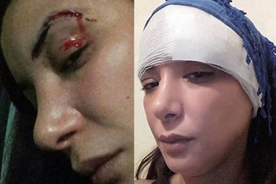 Nữ diễn viên bất ngờ bị đánh rách mặt vì đóng vai gái điếm