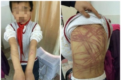 Trung Quốc: Mẹ nuôi 'ra tay' dã man vì con không làm bài tập