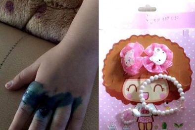 Kinh hoàng bàn tay bé gái bị phồng rộp nhiễm trùng vì chơi nhẫn đồ chơi Trung Quốc