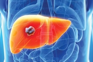 Những dấu hiệu cảnh báo bệnh ung thư gan nên biết