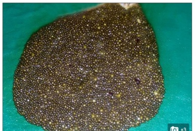 Rùng mình ca phẫu thuật lấy gần 12.000 viên sỏi trong túi mật 