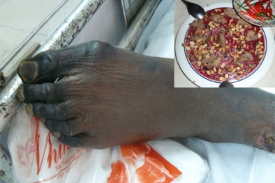 Ăn lợn sạch vẫn nhiễm liên cầu khuẩn như thường?