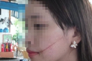 Nữ sinh lớp 9 bị bạn cùng học võ dùng dao nhọn rạch mặt