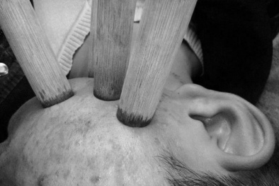 Nở rộ dịch vụ hút mụn bằng ống tre: Coi chừng nhiễm bệnh!