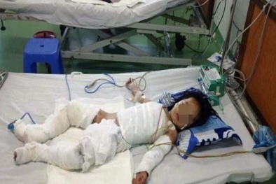 Tình trạng nguy kịch của bé 2 tuổi ngã vào nồi nước sôi