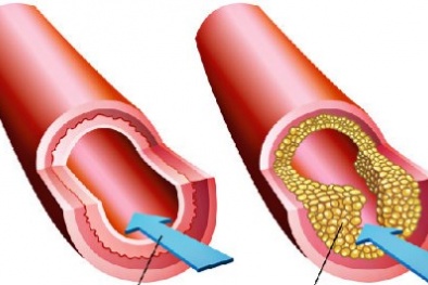 Nguyên tắc ăn uống dành cho người bị mỡ máu