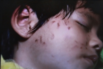 Bé gái 4 tuổi bị các bạn đánh hội đồng, cào rách mặt vì tè dầm