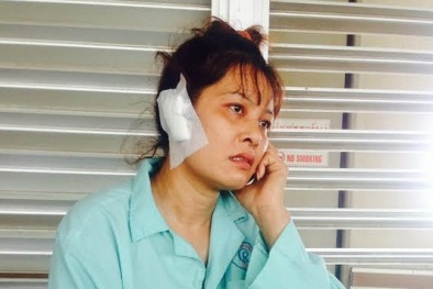 Một phụ nữ bị chồng cắn rớt tai