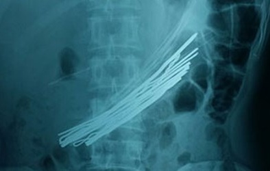 Cứu sống người đàn ông ‘ngáo đá’ nuốt nguyên cuộn dây thép dài 1,5m