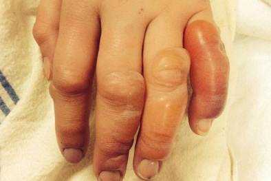 Coi chừng bỏng lạnh, hoại tử tay chân vì rét đậm rét hại