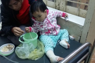 Bé gái 17 tháng tuổi bỏng nặng thân dưới do túi sưởi phát nổ