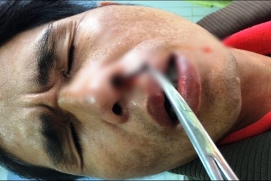 Rùng rợn những trường hợp đỉa ‘định cư’ trong mũi người ở Việt Nam
