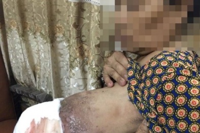 Ngực trái đau nhức, bốc mùi vì đắp thuốc nam