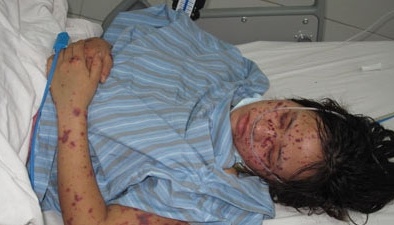 Viêm màng não mô cầu đã ‘tấn công’ Hà Nội