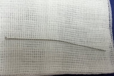 Hy hữu cây ráy tai bị kẹt ở xương sau màng nhĩ khi đi cắt tóc