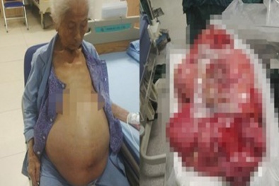 Phẫu thuật thành công khối u 13kg cho cụ bà 100 tuổi ở Đồng Nai