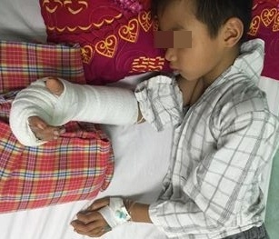 Bệnh viện Nhi Trung ương nối bàn tay bị chém gần đứt lìa cho bé trai 8 tuổi
