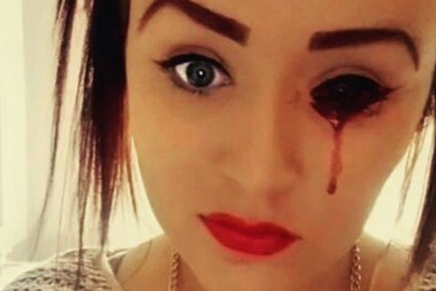 Bác sỹ bó tay trước cô gái có đôi mắt 'biết chảy máu'