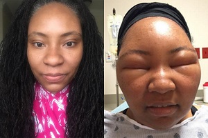 Mặt biến dạng vì thuốc nhuộm tóc