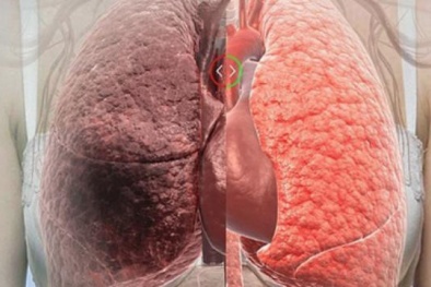 Không chỉ thuốc lá, đường cũng có thể gây ung thư phổi