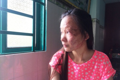 Từ vụ nữ sinh Sài Gòn bị tạt axit: Nguyên tắc sống còn khi bị tạt axit