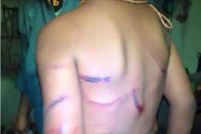 Trẻ bị cha dượng bạo hành thừa sống thiếu chết vì làm mất mấy chục nghìn