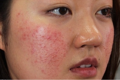 Hủy hoại khuôn mặt vì công thức làm đẹp da có chứa chất corticoid