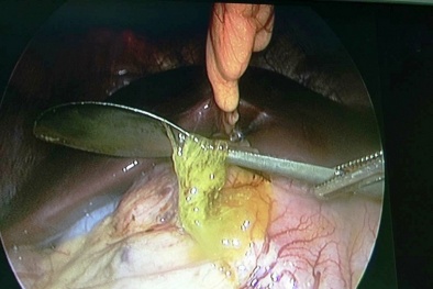 Bệnh viện Trung ương Huế lấy thành công chiếc muỗng trong ổ bụng bệnh nhân