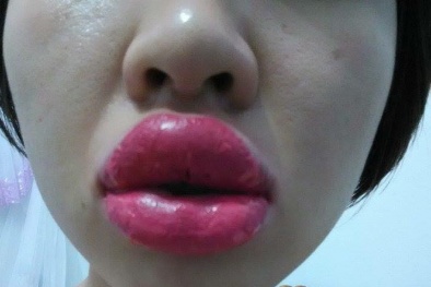 Hệ lụy khó lường từ phun xăm môi