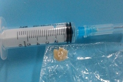 Hốt hoảng bé trai 2 tuổi suýt tử vong vì hóc mít 