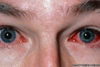 Khóc ra máu vì kính áp tròng kẹt trong mắt suốt 2 năm