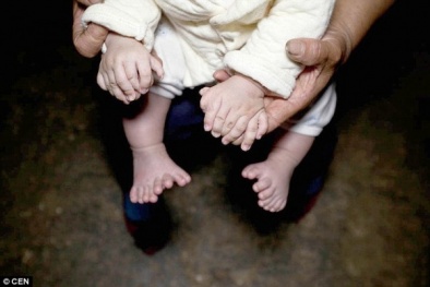 Sửng sốt với em bé có 15 ngón tay, 16 ngón chân ở Trung Quốc