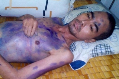 Diễn viên Nguyễn Hoàng lại bị 'hành hạ' bởi những cơn sốt li bì