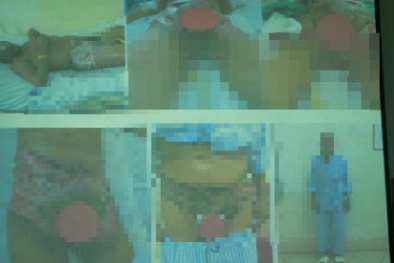 Bôi dầu gió vào 'vùng kín', người đàn ông suýt mất mạng vì nhiễm trùng lan rộng