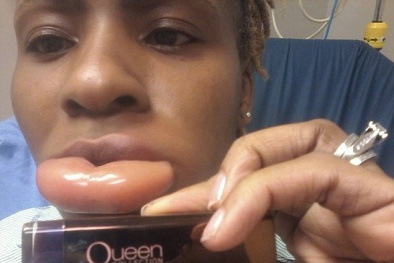 Sưng phồng môi vì bị dị ứng son