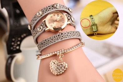 Nhiễm trùng, lở loét tay vì đồng hồ trang sức… rởm