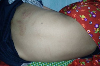 Bị mèo cào, bé trai tử vong vì lây bệnh dại