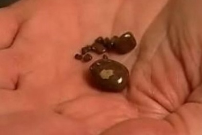 Bí quyết loại bỏ sỏi thận tại nhà mà không cần phẫu thuật