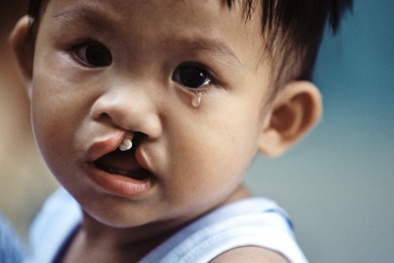 Nguy cơ dị tật bẩm sinh vì mẹ thích ăn đồ ngọt