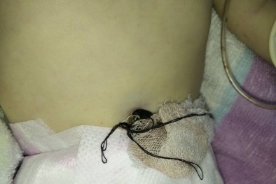 Cắt rốn bằng kéo, buộc bằng chỉ khâu quần áo, bé sơ sinh hút chết vì uốn ván